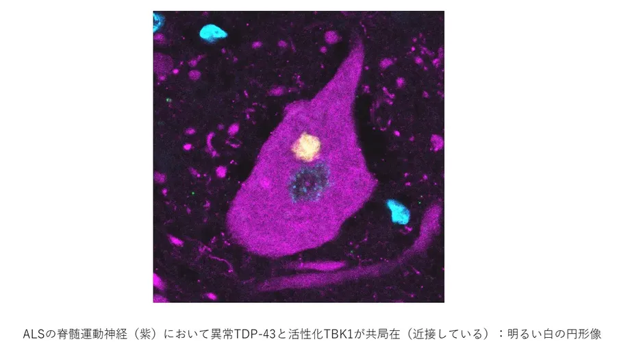 Nagoya Researchers Identify New Route for Clearing Protein Linked to ALS